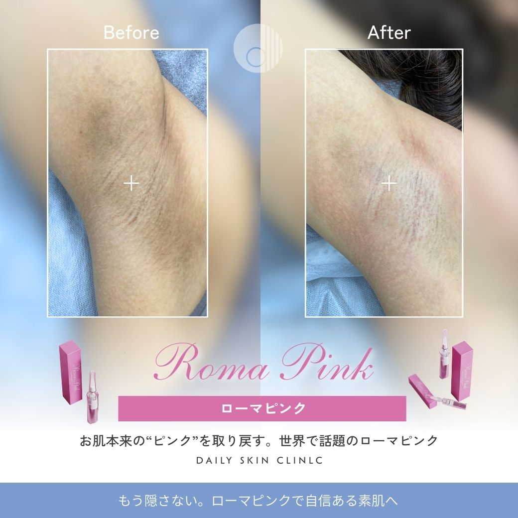 ローマピンク | 新宿・大阪心斎橋・名古屋・福岡の美容クリニック