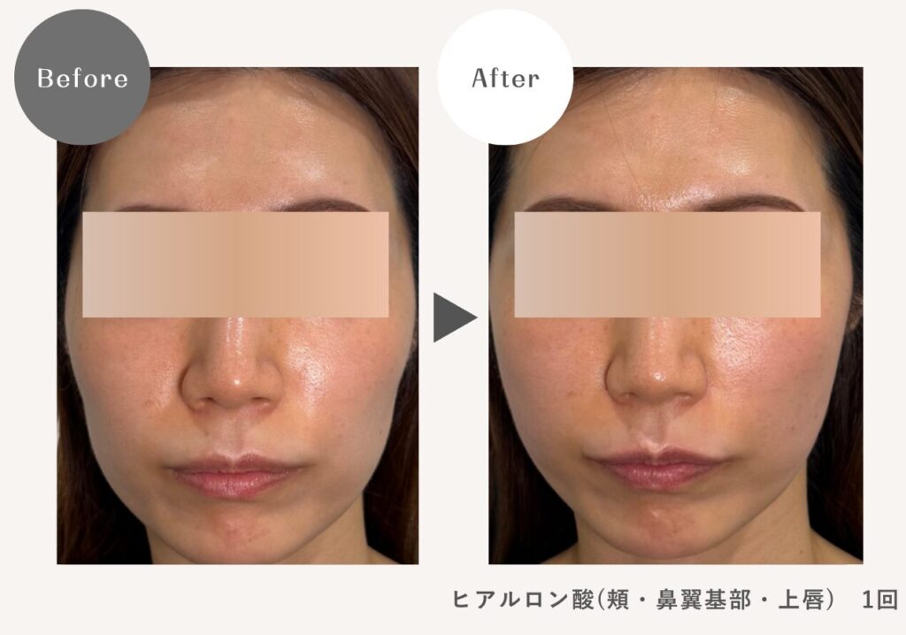 頬・鼻翼基部・上唇 症例